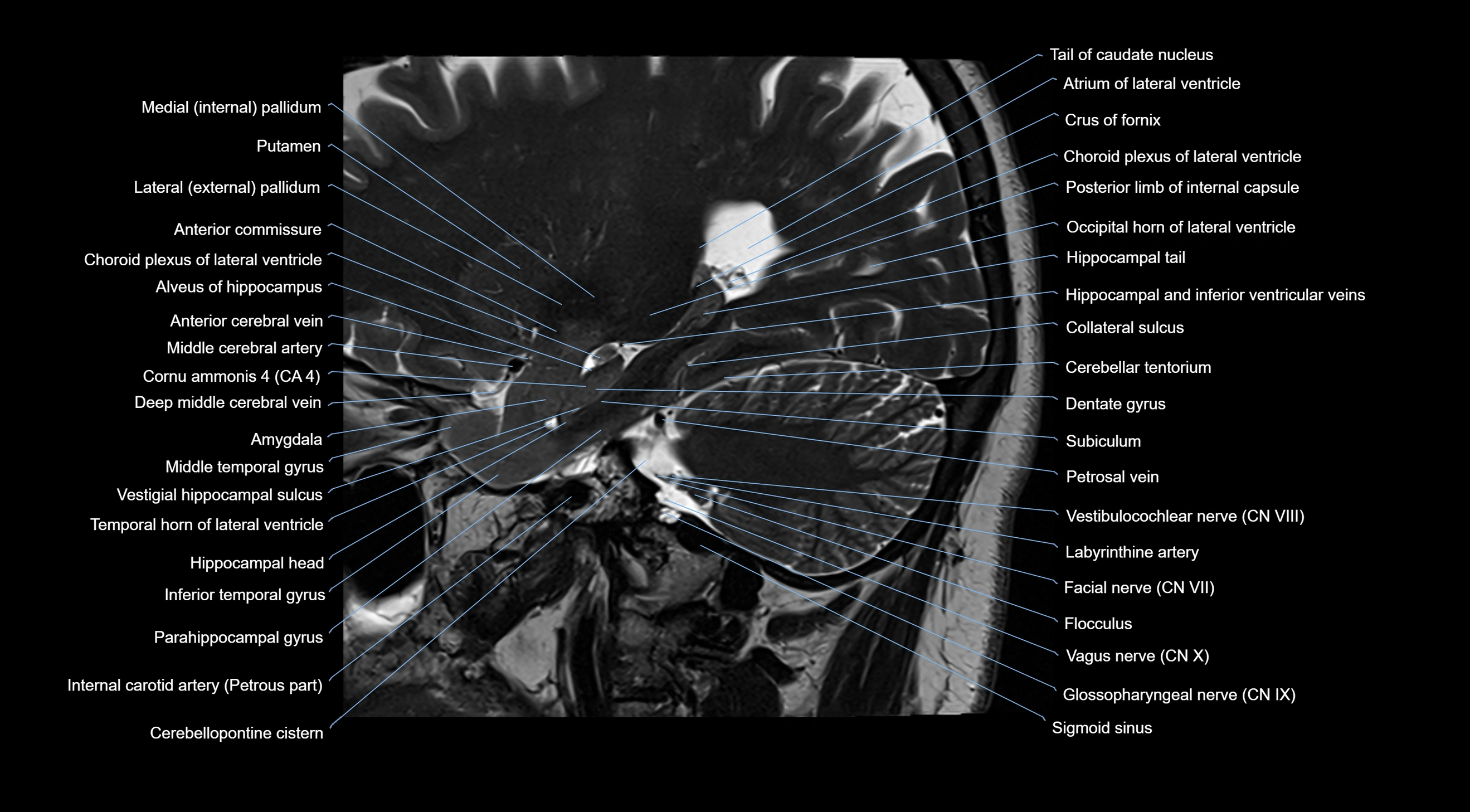 MRI brainstem & basal ganglia anatomy labelled  3T MRI images -img-10001-00014.webp
